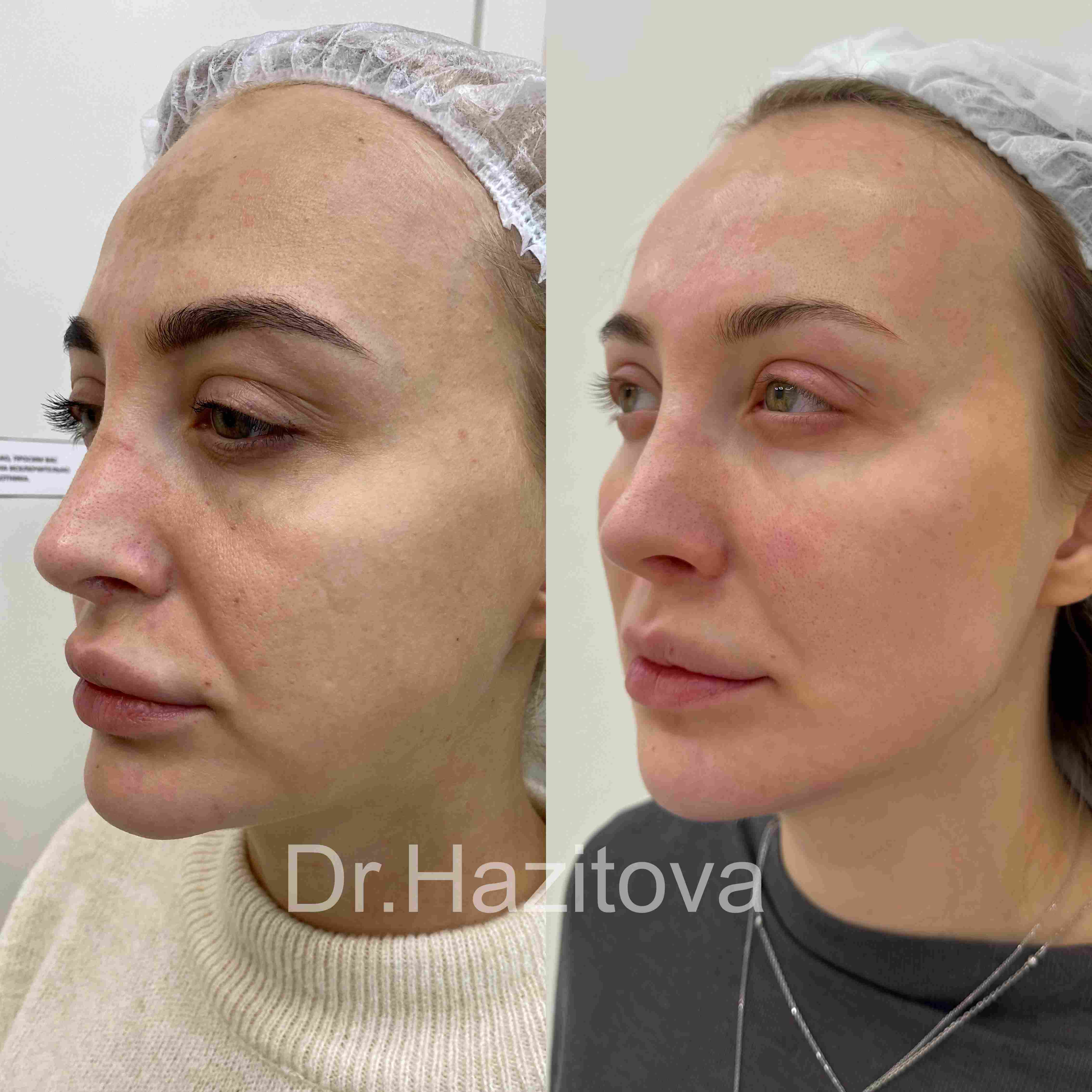 Фото результата процедуры у врача-косметолога Хазитовой Ильмиры Рафисовны - 11